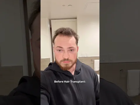 Hair Transplant BEFORE & AFTER 😱