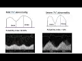 VExUS Score - USG