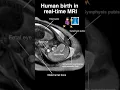 Download Lagu Human BIRTH in real-time MRI! #radiology #womenshealth #anatomy
