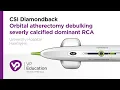 CSI Diamondback Orbital atherectomy debulking severly calcified dominant RCA