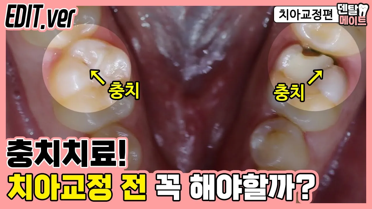 치아교정 하기 전 충치치료 꼭 해야 하나요? (치료해야 하는 충치, 안 해도 되는 충치 판단하는 기준)｜덴탈메이트 치아교정편