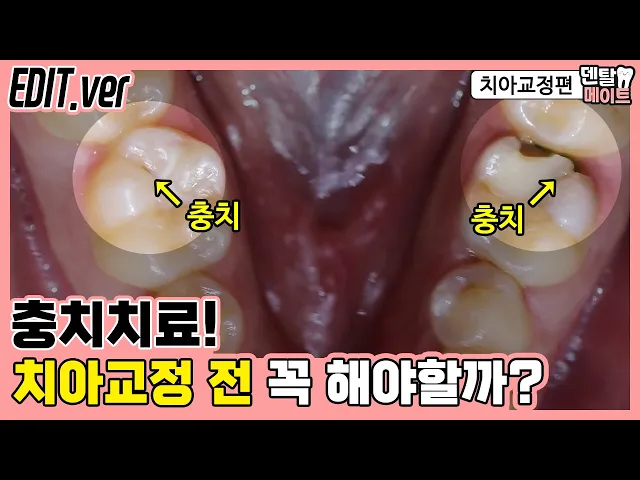 치아교정 하기 전 충치치료 꼭 해야 하나요? (치료해야 하는 충치, 안 해도 되는 충치 판단하는 기준)｜덴탈메이트 치아교정편