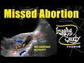 Missed Abortion 9-10 Weeks Ultrasound Case 331