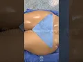 Perfect Curves Tummy Tuck BBL Results at Vive Plastic Surgery