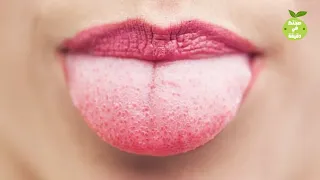 10 طرق طبيعية سريعة وفعالة لعلاج حروق اللسان 
