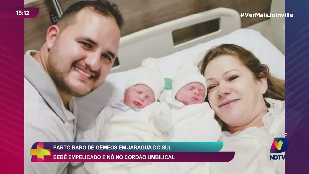 Parto raro de gêmeos em Jaraguá do Sul: bebê empelicado e nó no cordão umbilical