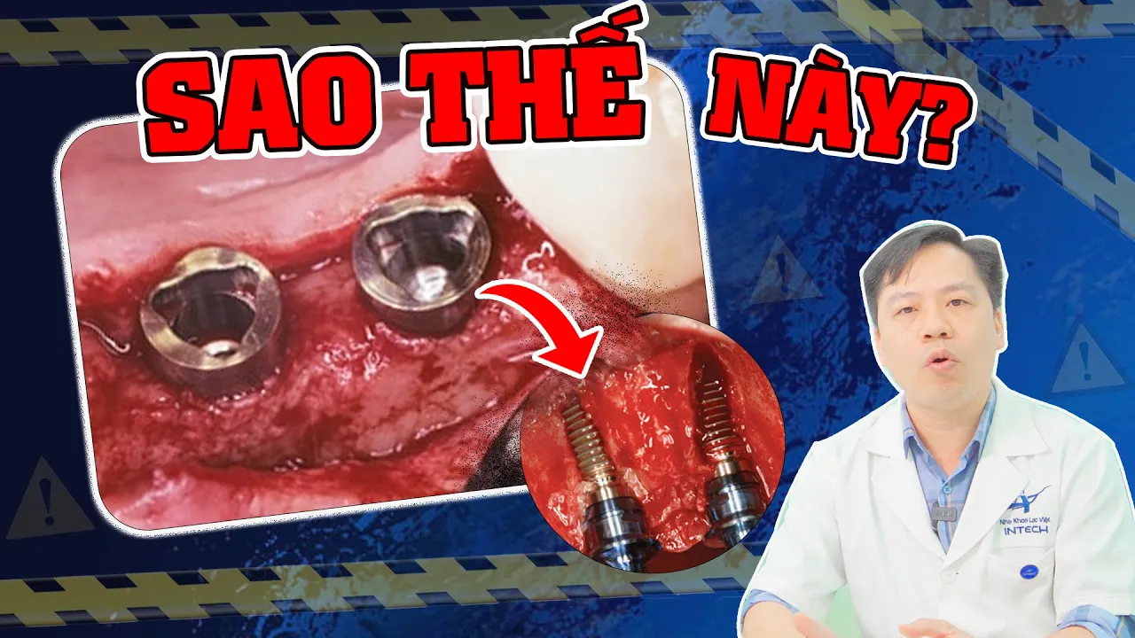 Outline Video 3 Nhóm Tác Hại Của Trồng Răng Implant| Đặc Biệt Nhóm Tác Hại Thứ 2 Không Thể Coi Thường!