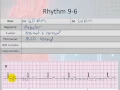 Basic Electrophysiology part 6 - Sinus Node Rhythms