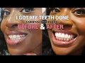 Download Lagu I GOT MY TEETH DONE - BEFORE \u0026 AFTER RESULTS OF COMPOSITE BONDING TREATMENT | VLOG
