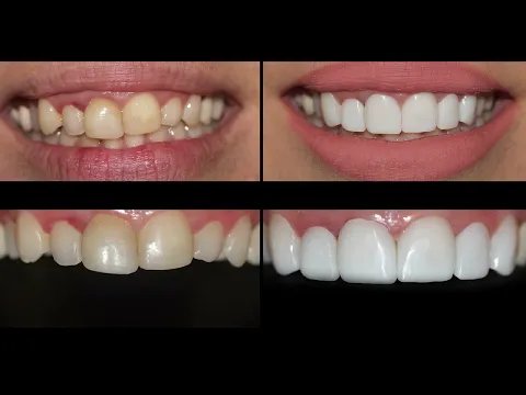 Download MP3 Smile Makeover. Prepless porcelain dental veneers before and after cosmetic dentistry.