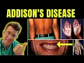 Doctor explains Addison s disease Adrenal insufficiency definition symptoms treatment more