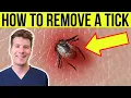 Doctor explains HOW TO REMOVE A TICK Step-by-step guide