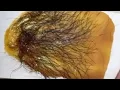 Download Lagu Brazilian sugaring sugarwaxing:Brazilian Experience#brazilian#viralvideo#sugaring#waxing #wax