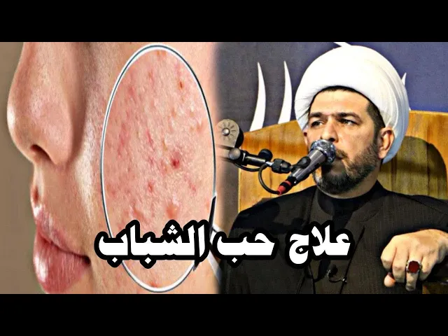 ⁣تخلص من حب الشباب نهائياً وبسرعة !!