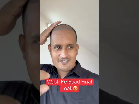 Head Wash Ke Baad Baal Kaisa DikhtaHai? 😍 Pehle Wash Ke Baad Itna Saaf? #shorts #hairtransplant