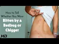 Bug Bite Mystery Solved Bedbugs or Not