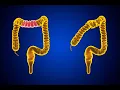 CPT code for Colectomy partial - simplify medical coding