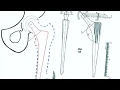 Step-by-Step Approach to templating in Total Hip Replacement