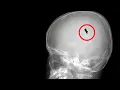 His skull was healed by a-