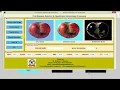 Fruit Disease Detection and Classification Using Image Processing