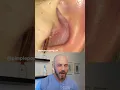 Download Lagu Massive ear pimple pop! #dermreacts #doctorreacts #pimplepop
