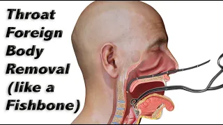 How a Fishbone (or Other Foreign Body) is Removed from the Throat Without Sedation