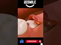 Download Lagu Impacted wisdom tooth removal #shorts