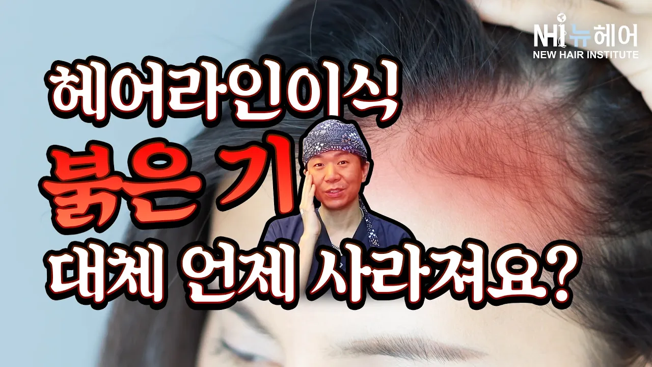 헤어라인 모발이식 붉은 기 언제 사라지나요?｜뉴헤어