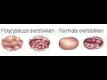 Download Lagu Wat is Polycysteus Ovarium Syndroom en hoe wordt het behandeld?