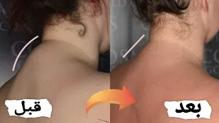 تحدب او سنام الرقبه اسبابه وعلاجه بتمارين منزليه بسيطه  علاج تقوس الظهر وبروز عظام الرقبه من الخلف دندنها