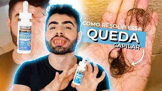 Minoxidil Funciona Mesmo? Tratamento Eficaz Contra Queda Capilar