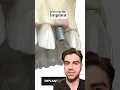 Tooth Implant Procedure STEP BY STEP - Explained
