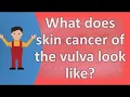 Download Lagu What does skin cancer of the vulva look like ? |Top Health FAQS