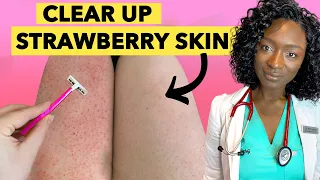 Download 🍓 Strawberry Legs - Why it Happens \u0026 How to Get Rid Of It + Products MP3