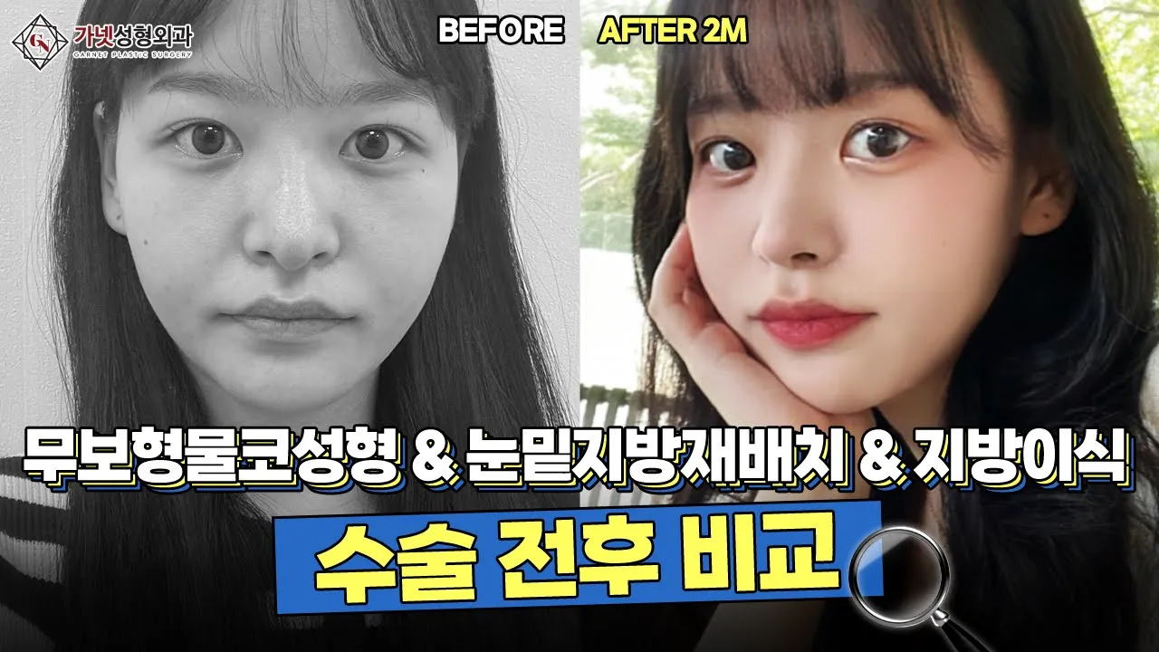 무보형물코성형+눈밑지방재배치+풀페이스 지방이식으로 러블리함 한 가득!💕 가넷성형외과 Before&After💌