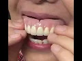 Download Lagu Finished Denture in the Mouth