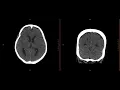 Neuroradiology Call Prep Cases Acute Subdural Hematoma CT Case 10 Discussion