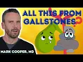 Choledocholithiasis