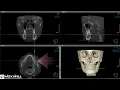 Creating a diagnostic view on OnDemand3D with HDXWILL Dentri α imaging.