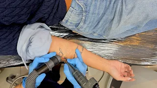 Quer saber como uma tatuagem é realmente removida? A resposta está aqui! | Remoção de Tatuagem