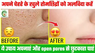 ओपन पोर्स छुटकारा पाने के अचूक तरीके |Say Goodbye to Open Pores: Effective Tips and Tricks Revealed!