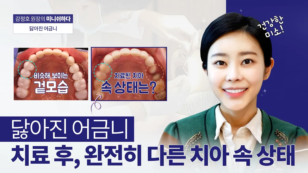 어금니 닳았을 때, 꼭 크라운이 답일까요?ㅣ치과의사가 말하는 보존적 치료법