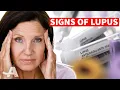 Download Lagu 5 Early Signs of Lupus