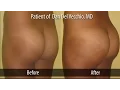 Are BUTT lifts more popular than breast lifts - No Spin Live