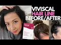 YES VIVISCAL SUPPLEMENTS WORKED Hair Loss Sufferer s 3 Month Hair Regrowth Experience