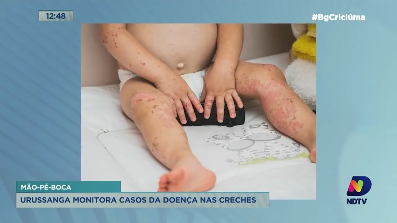 Surto da doença 'mão-pé-boca' é monitorado em Urussanga