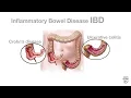 Mayo Clinic Minute What is inflammatory bowel disease