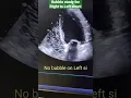 Bubble study for Right to Left shunt PFO