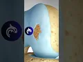 Download Lagu See how Damaged Knee Cartilage is restored in 3D Animation. Osteochondral Autograft (OAT)
