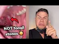 These May Look Like Tonsil Stones But They Are WAY Worse